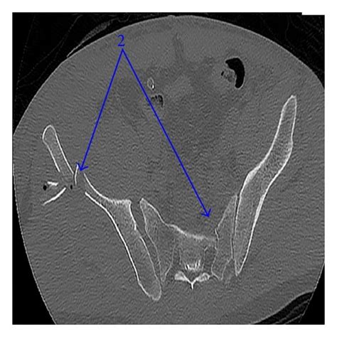 A X Ray Image Of The Pelvic Fracture Four Months After Trauma 1