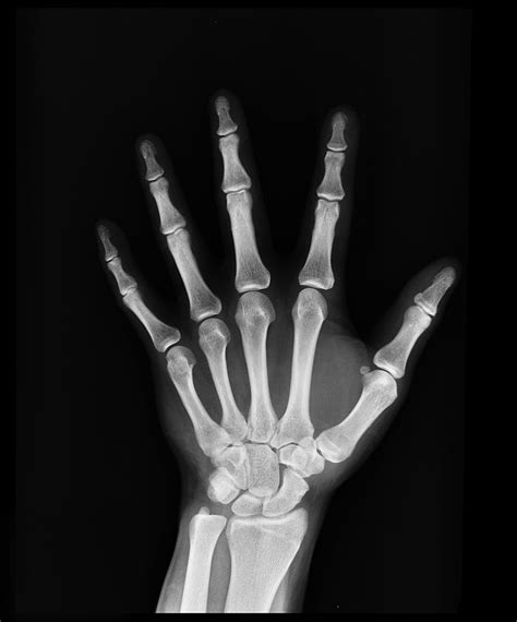 De Quervains Tenosynovitis Orthopedic Doctor Louisville Ky Hand Injury