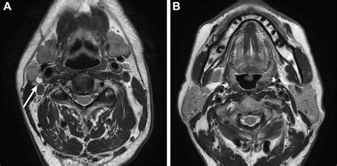 Imaging Approach For Cervical Lymph Node Metastases From Unknown