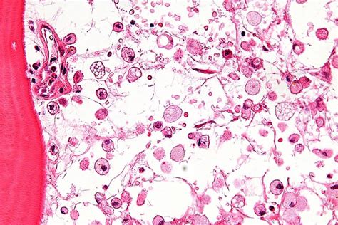 Live Gc Labs Medical Lysosomal Storage Disease Lsd