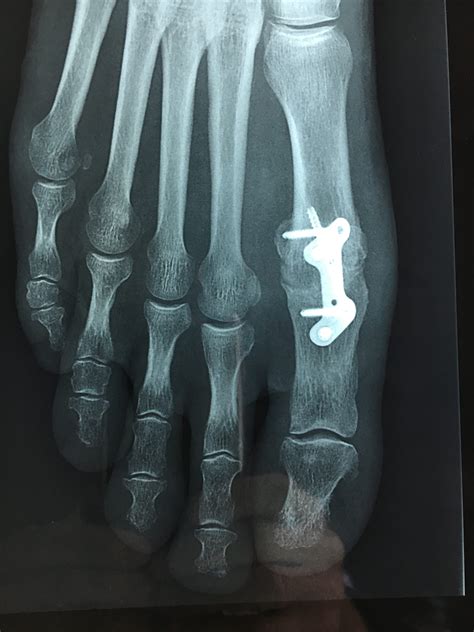 Hallux Rigidus X Ray