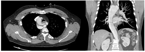 Scvs Hybrid Management Of Acute Type B Aortic Dissection In A Patient