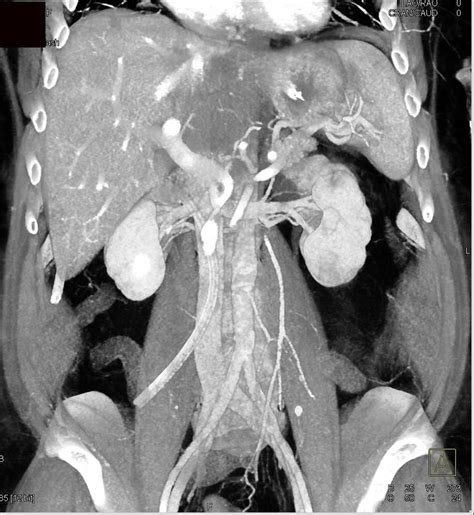 Focal Fatty Infiltration of the Liver / CTisus.com | Liver, Case study, Infiltration