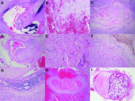 Arteriovenous Malformation Histology