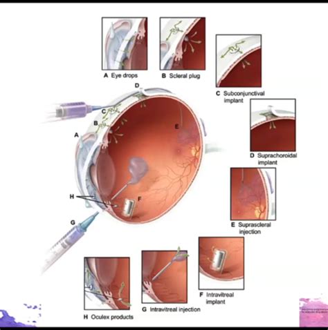 Ophthalmic Drug Drops Ophthalmic Drug Delivery Preservative Vehicles