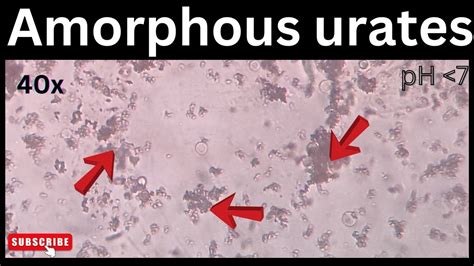 Amorphous Urates In Urine