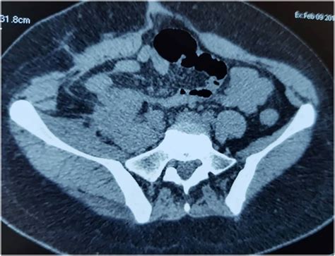 CT Scan 2 months postoperatively: stability of the tumoral residue on ...