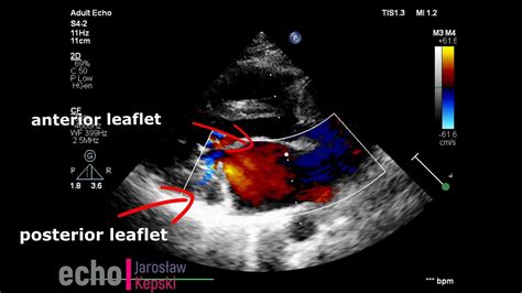 Myxomatous Mitral Valve Degeneration Mmvd Posterior Leaflet Mitral