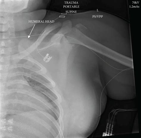 Preoperative Anteroposterior X Ray Of The Left Shoulder Showing Download Scientific Diagram