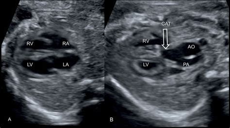 Truncus Arteriosus Fetal Ultrasound