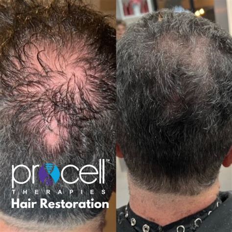 ProCell Hair Restoration Incentives Organic Spa Salon