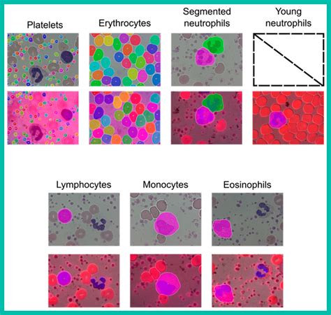 Artificial Intelligence In Hematology Ask Hematologist Understand