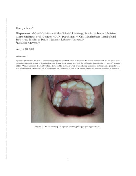 PDF Pyogenic Granuloma Of The Gingiva A Case With Severe Bone Loss