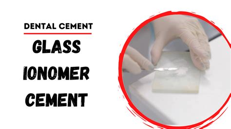 Dental Cements Explore The Versatility Of Glass Ionomer Cement