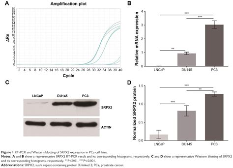 High Srpx2 Protein Expression Predicts Unfavorable Clinical Outcome In Ott