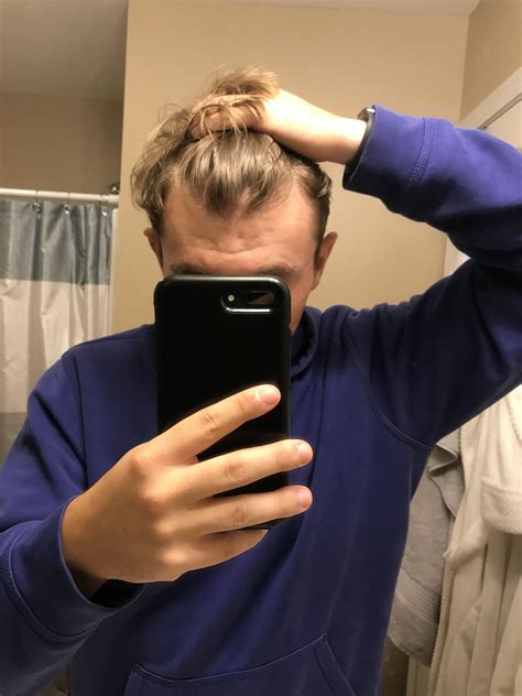 men are sharing their best tips for hair thinning at hairline male