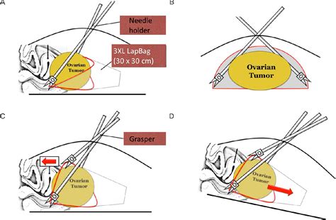 Table 1 From Surgical Technique For Single Port Laparoscopy In Huge