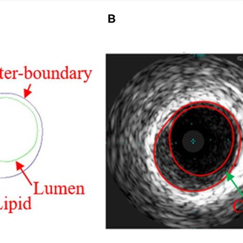 A Virtual Histology Intravascular Ultrasound Vh Ivus Slice And