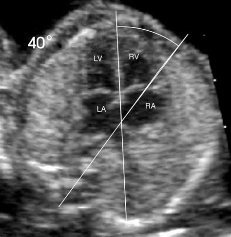 Cardiac Axis In Fetuses With Abdominal Wall Defects Boulton 2006