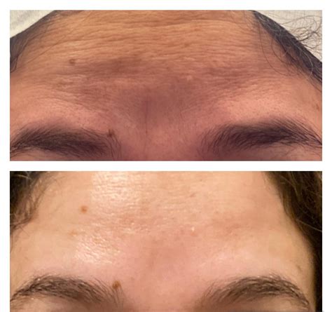 Prp Prf For Face Sf Aesthetic And Wellness