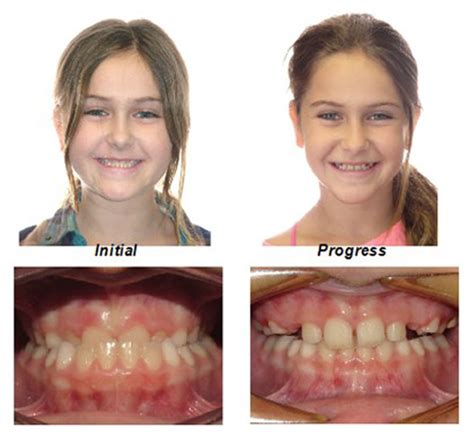 Smile Gallery Millburn Nj Millburn Orthodontics