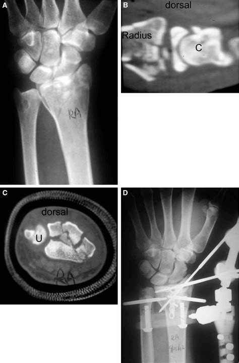 Pdf Nonbridging External Fixation Of Intra Articular Distal Radius Fractures Semantic Scholar