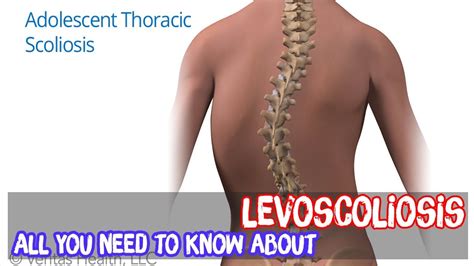 All You Need To Know About Levoscoliosis YouTube