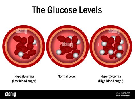 Niveles De Glucosa En Sangre Nivel Normal Hiperglucemia E