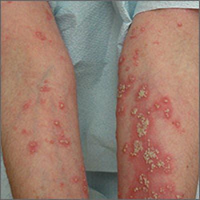 Worsening rash | MDedge Family Medicine