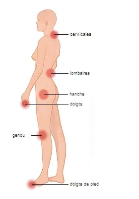 Arthrose causes symptômes et traitements VIHCO