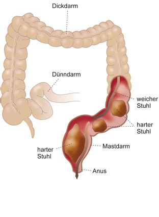 Obstipation Verstopfung München Behandlung Darmspiegelung