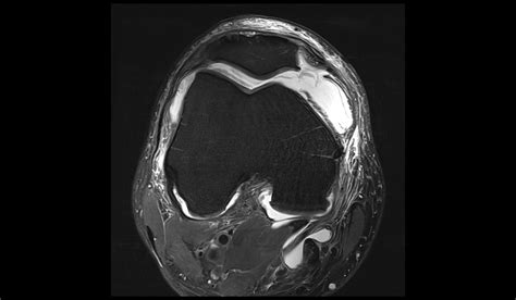 Baker's cyst rupture MRI | Radiology Article on Baker cyst rupture