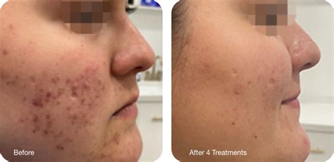 Opus Plasma Fractional Plasma Skin Resurfacing