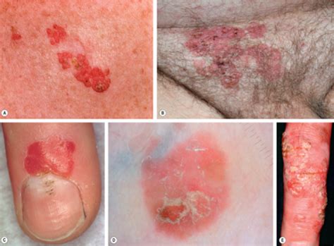 Carcinoma Epidermoide