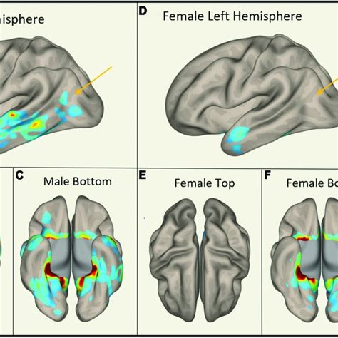 Sex Specific Pathological Features With Right Hippocampus As Roi Download Scientific Diagram