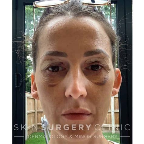 Top Pictures Lower Blepharoplasty Recovery Photos Day By Day Updated