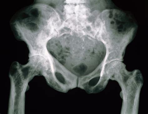 Paget's Disease Breast Mri at hazelestevero blog