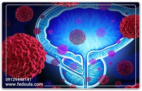 معجون درمان پروستات بهترین روش درمانی در طب سنتی