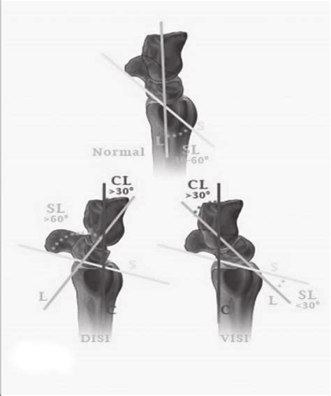 Lateral Projection Of The Carpal Bones In Normal Position And With