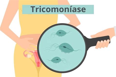 Tricomoníase O Que é Transmissão Sintomas Brasil Escola