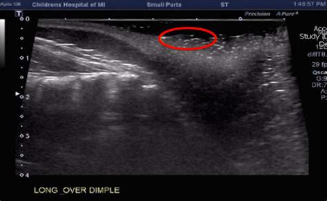 Sacral Dimple Causes Newborn Adults Ultrasound And Management