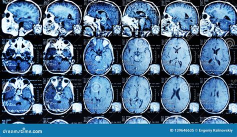 MRI Scan of a Patient with a Tumor in the Brain Stem. Stock Image ...