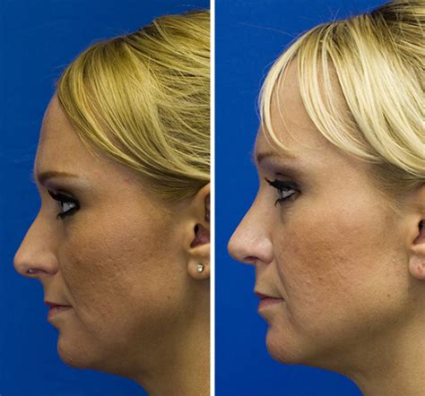 Hanging Columella Rhinoplasty In Seattle Rhinoplasty Surgeon