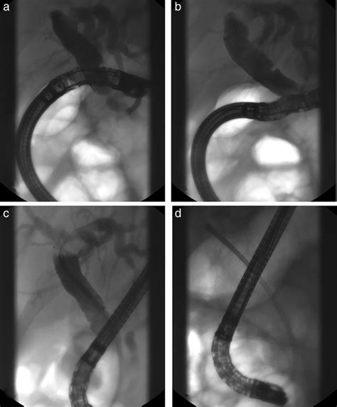 Endoscopic Retrograde Cholangiography Illustration Of The Long Scope