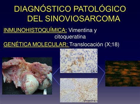 Ppt Malignizaci N De Sinovitis Villonodular Pigmentada A