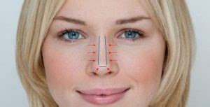 Rhinoplastie Medicale Tunisie Refaire Le Nez Par Injection Sans