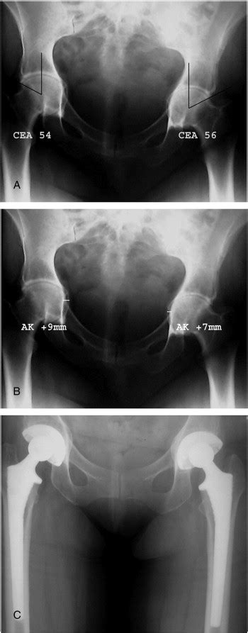 Protrusio Acetabuli And Total Hip Arthroplasty In Patients With Marfan