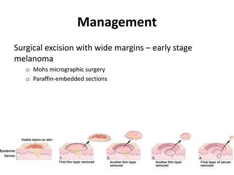 Malignant Melanoma Of The Eyelid Ppt