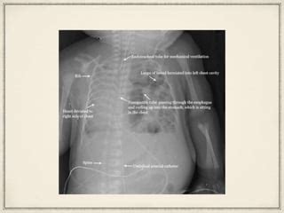 Diaphragmatic hernia in children | PPT