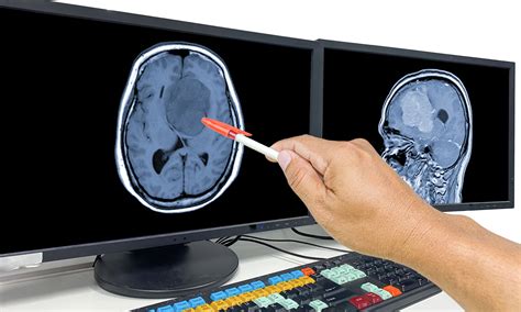 Multiomics Reveals An Expanded Molecular Landscape Of High Grade Glioma